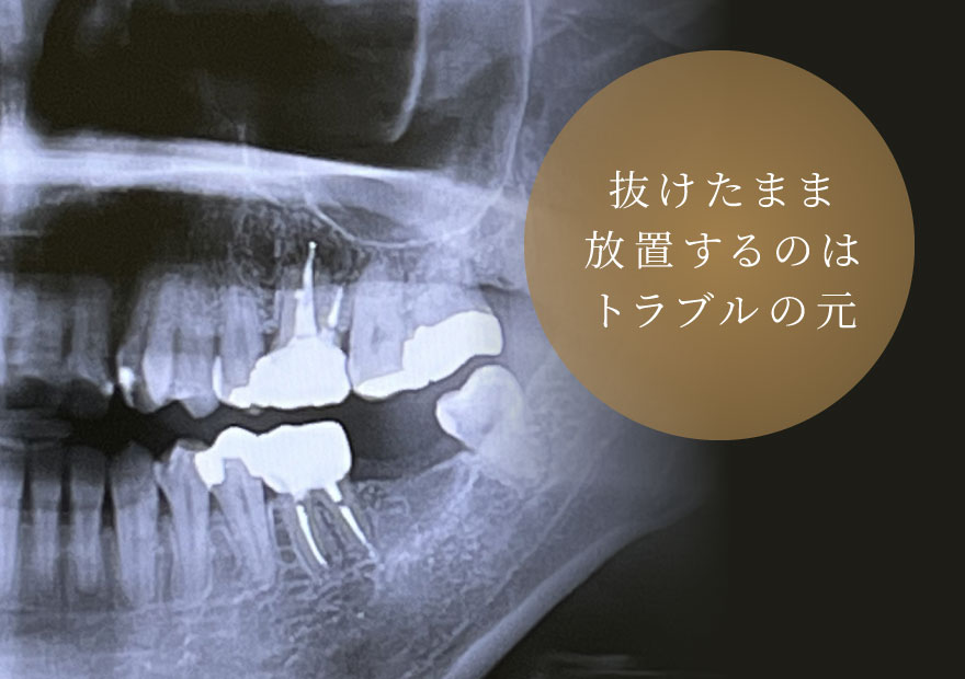 抜けたまま放置するのはトラブルの元