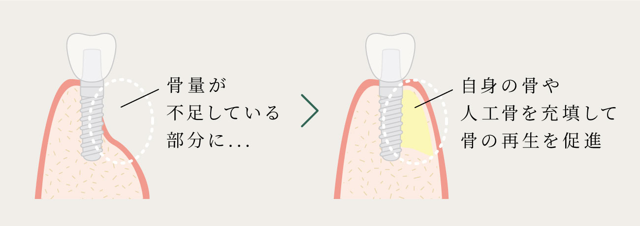 GBR(骨誘導再生法)