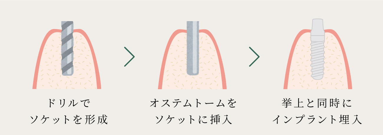 オステオトーム(骨拡大挙上術)