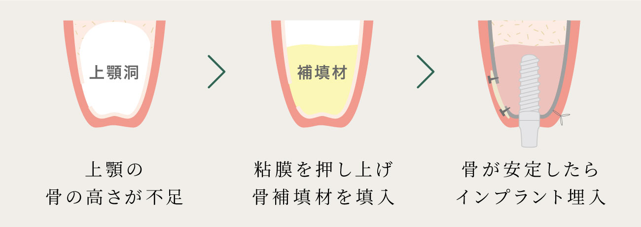 サイナスリフト(上顎洞底挙上術)