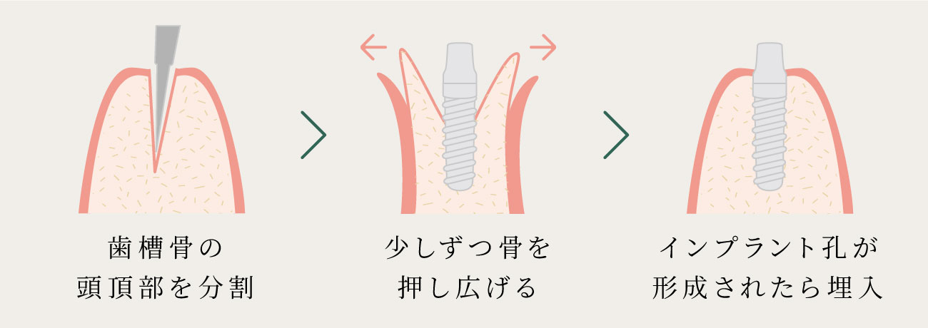 スプリットクレスト(歯槽骨分割拡大術)