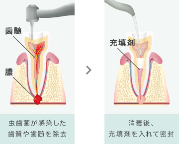 虫歯菌が感染した歯質や歯髄を除去し消毒後、充填剤を入れて密封