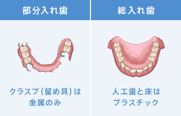 保険診療の入れ歯：クラスプ（留め具）は金属のみ、人工歯と床はプラスチック