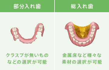 自由診療の入れ歯：クラスプが無いものなどの選択が可能、金属床など様々な素材の選択が可能