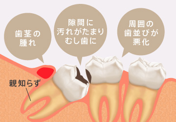 歯茎の腫れ、、隙間に汚れがたまりむし歯に周囲の歯並びが悪化