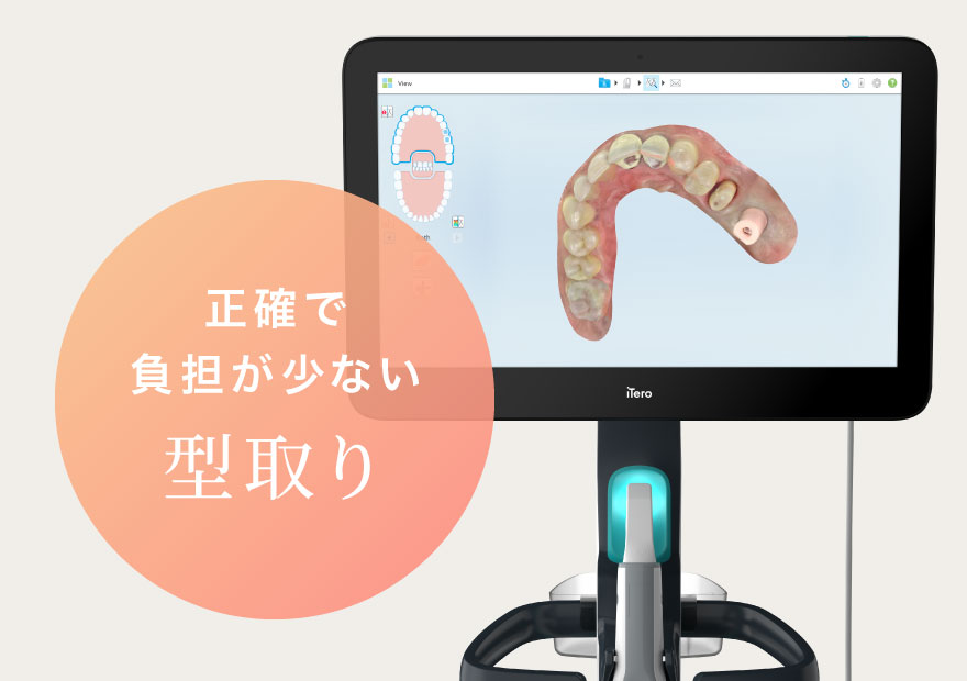 正確で負担が少ない型取り