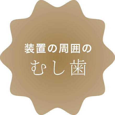 装置の周囲のむし歯