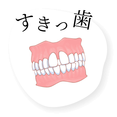 すきっ歯