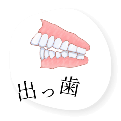 出っ歯