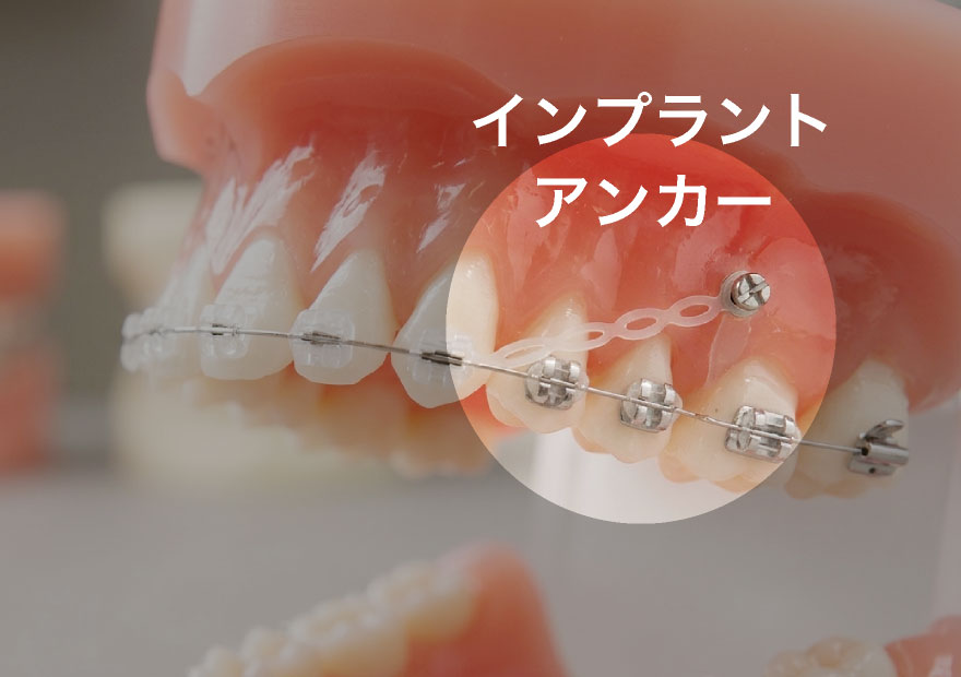 インプラントアンカー(補助装置)
